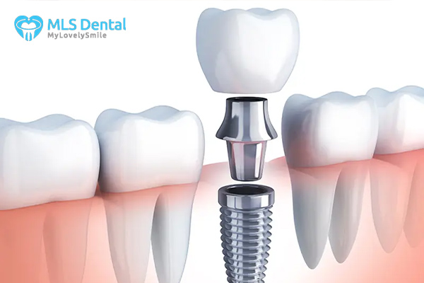 diş implantı