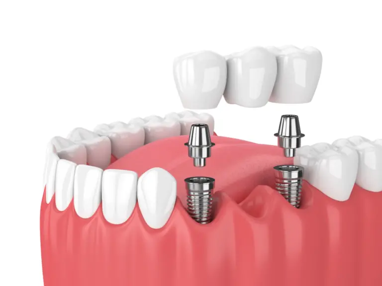 implant fiyatları 2025