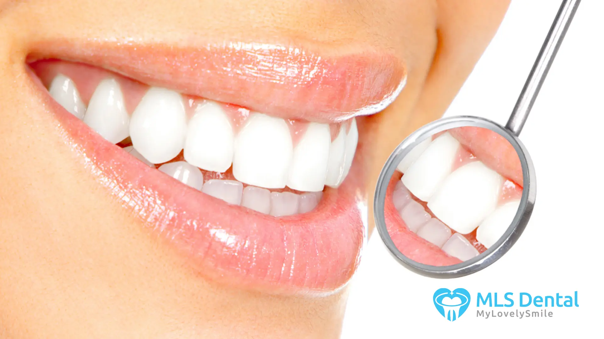 diş beyazlatma fiyatları MLS Dental
