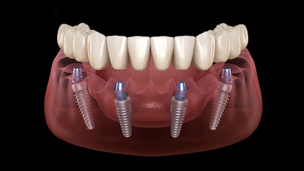All On Four implant