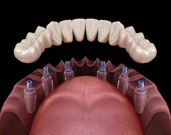 All On Six implant