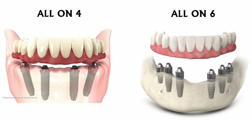 all on 4 ve all on 6 implant