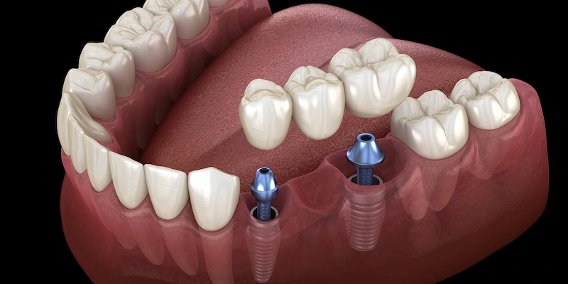 en iyi yerli ve ithal implant markaları