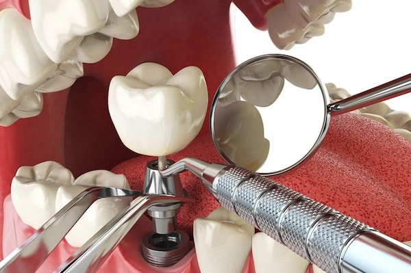 en iyi yerli ve ithal implant markaları
