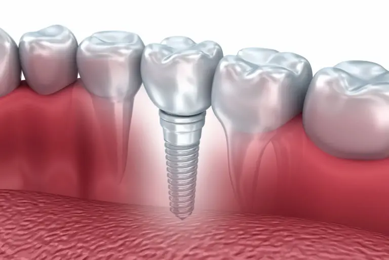 en iyi yerli ve ithal implant markaları